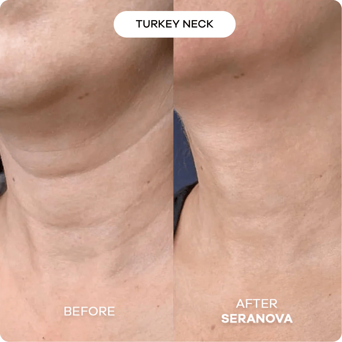 The Micro Infusion Syste