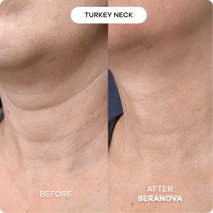 The Micro Infusion Syste